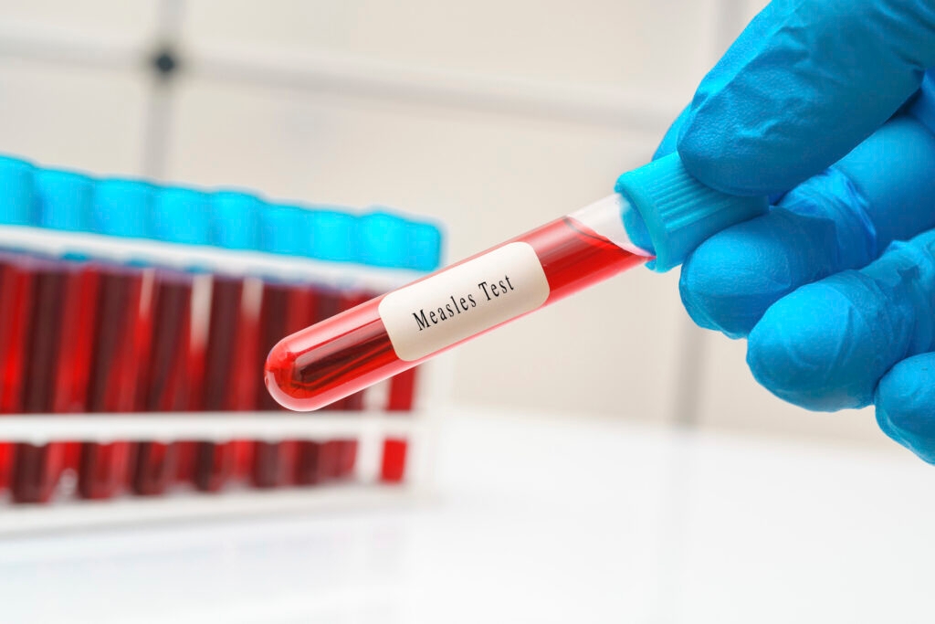 New Mexico health officials report measles exposures in San Juan, Lea county hospitals