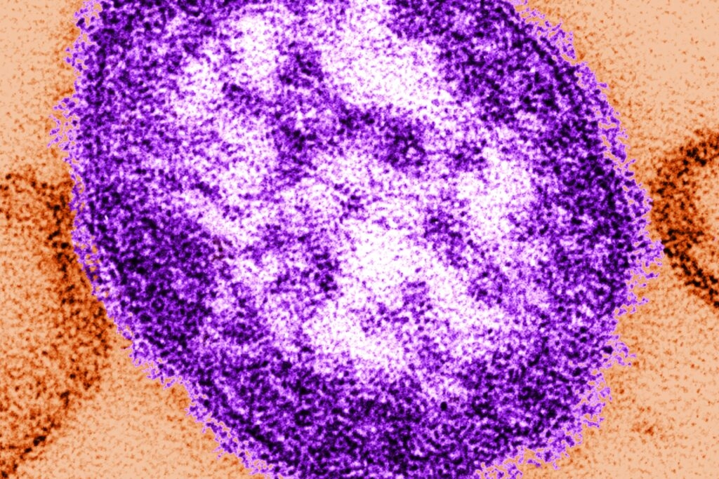 Nebraska confirms state's first measles case since 2017, in county bordering SD