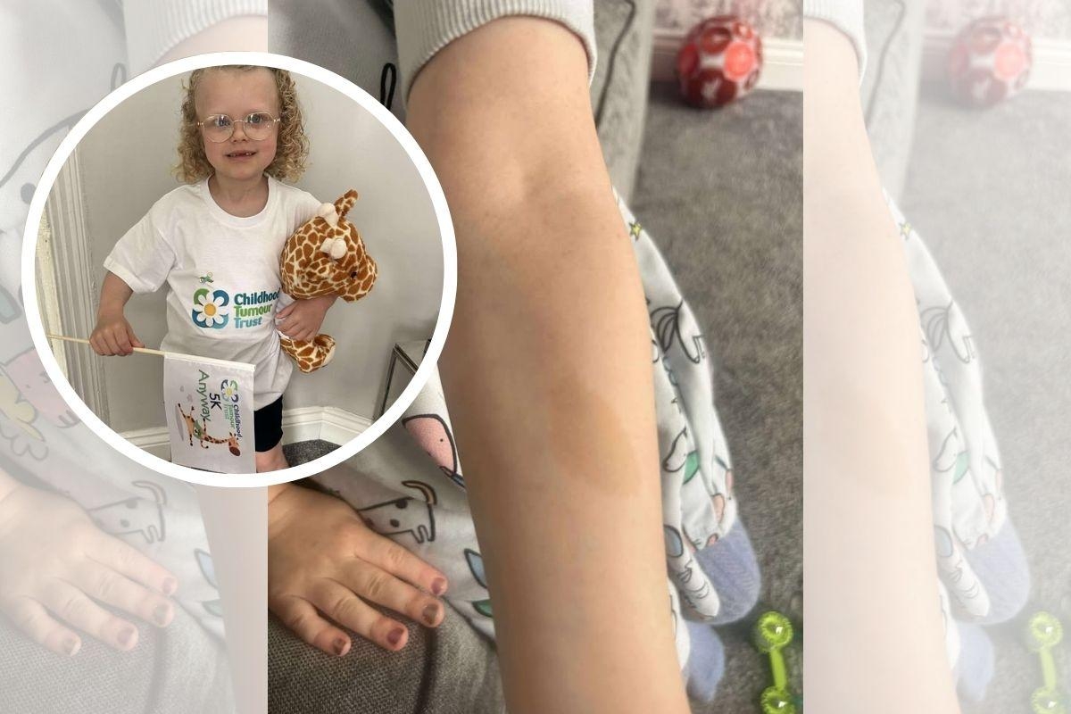 Family of Newport girl with rare skin condition on pain of diagnosis