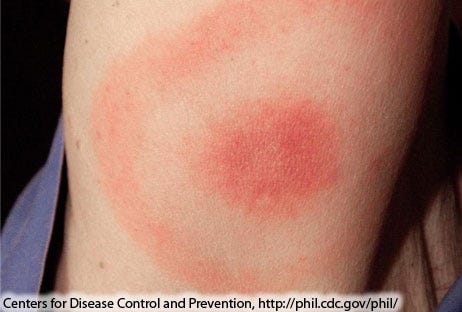 Lyme disease is on the rise; how you can protect your child, family from Lyme disease