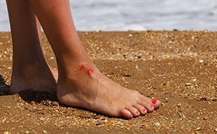 ‘Flesh-eating' bacteria linked to first Florida deaths of 2025; one near Jacksonville