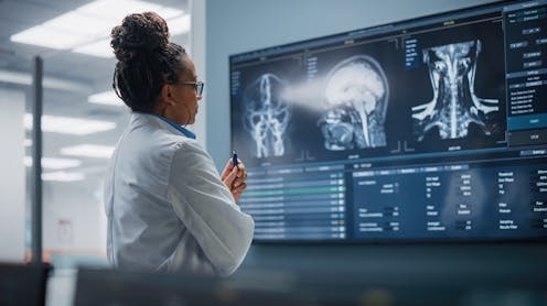 Brains of people with schizophrenia may age faster – how our research adds to the evidence