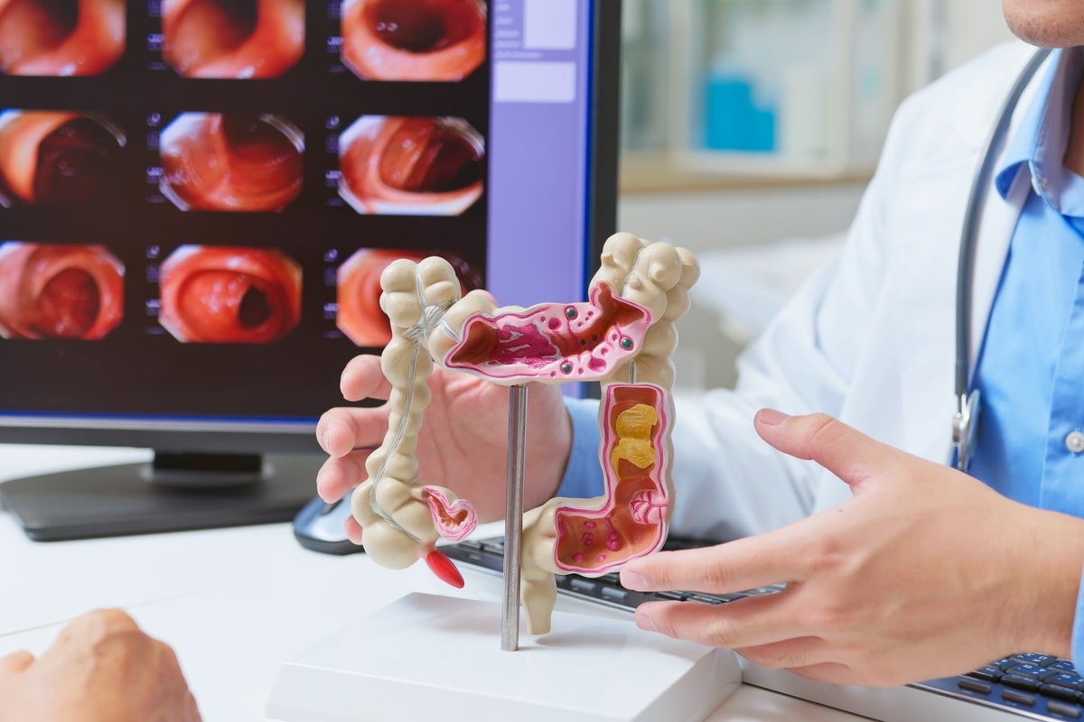 How a bowel cancer examination revealed AI's negative impact on doctors