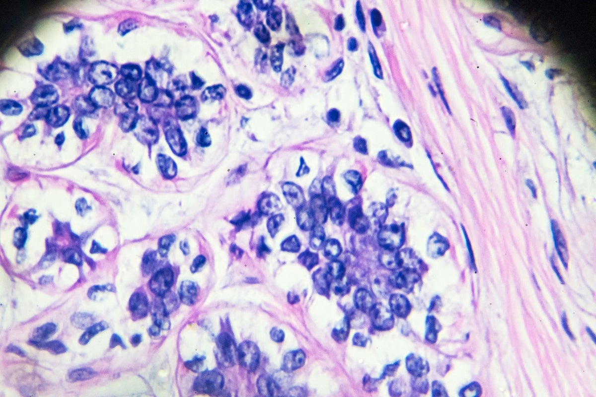 ‘Transformational' new breast cancer drug could halt the growth of tumours