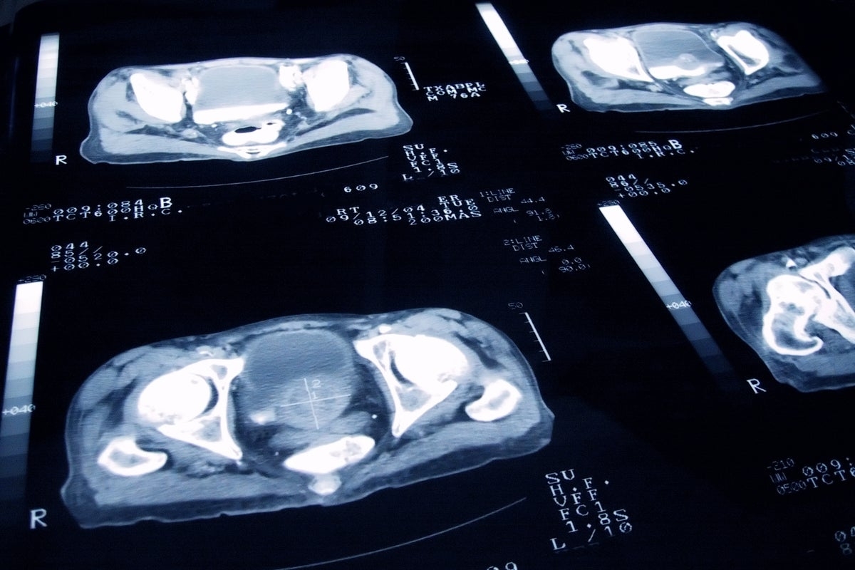 AI to help end ‘postcode lottery' for vital prostate cancer drug