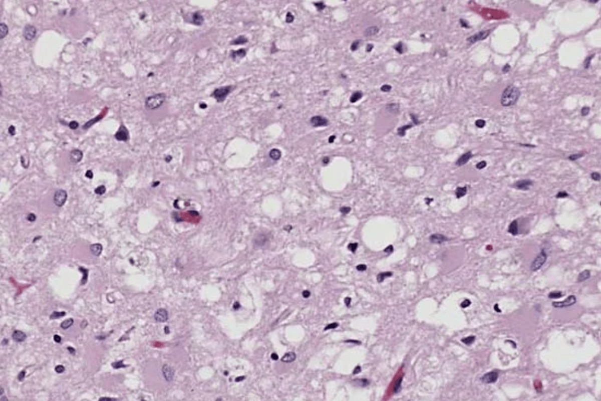 Two dead, another infected, as rare brain disease reported in one Oregon county