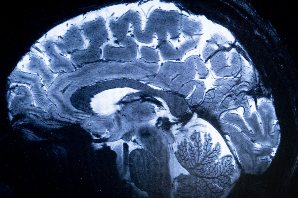 Breakthrough study finds deficiency of this common nutrient could contribute to Alzheimer's