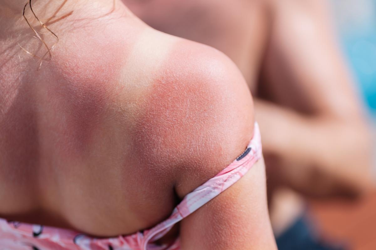 Skin cancer warning issued over wearing shorts and skirts or being topless