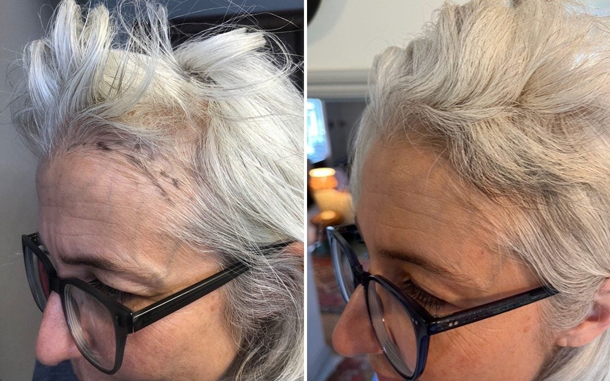 I've tried almost every cure for thinning hair — this is what worked