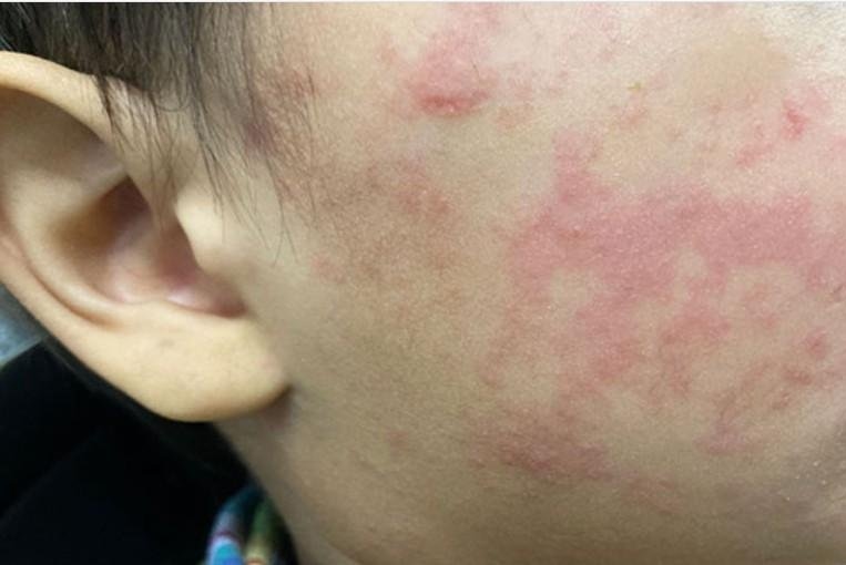 'This should not be happening,' doctor says as measles cases rise to more than 900 in U.S.