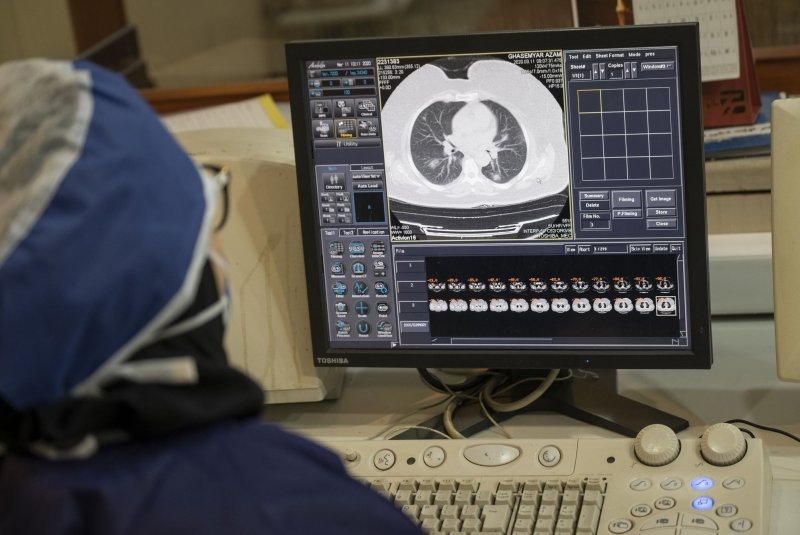 Lung cancer risk in never-smokers predicted by AI tool 'Sybil'