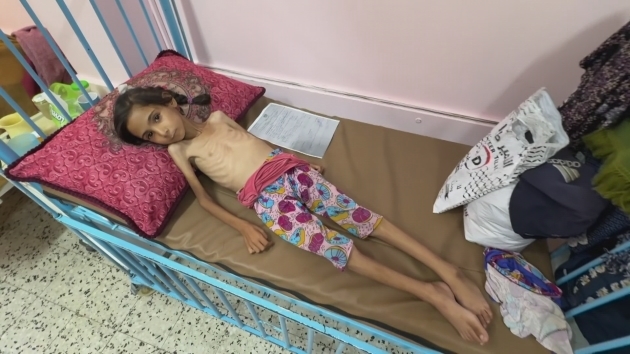 ITV News meets Amal, a severely malnourished girl in Gaza