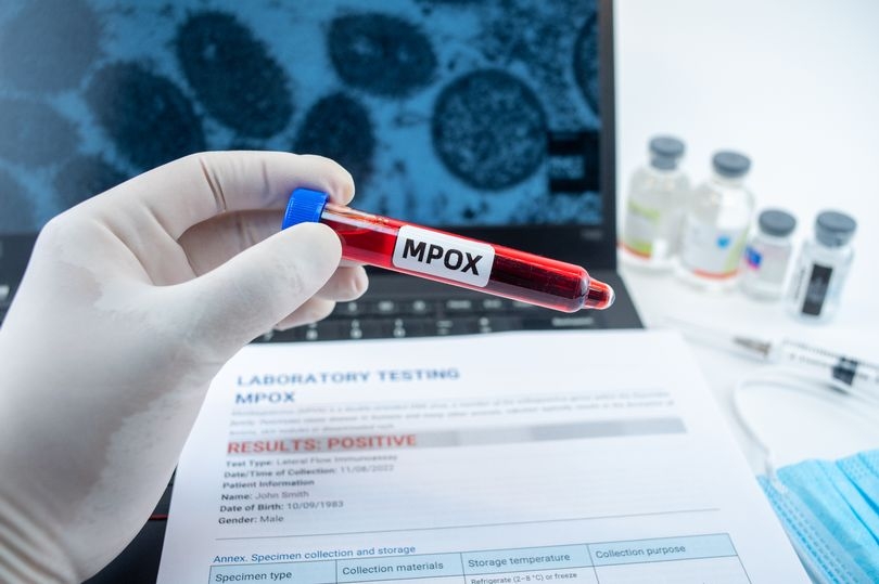 UKHSA investigation after patient found to have Clade Ib mpox with no links to confirmed cases