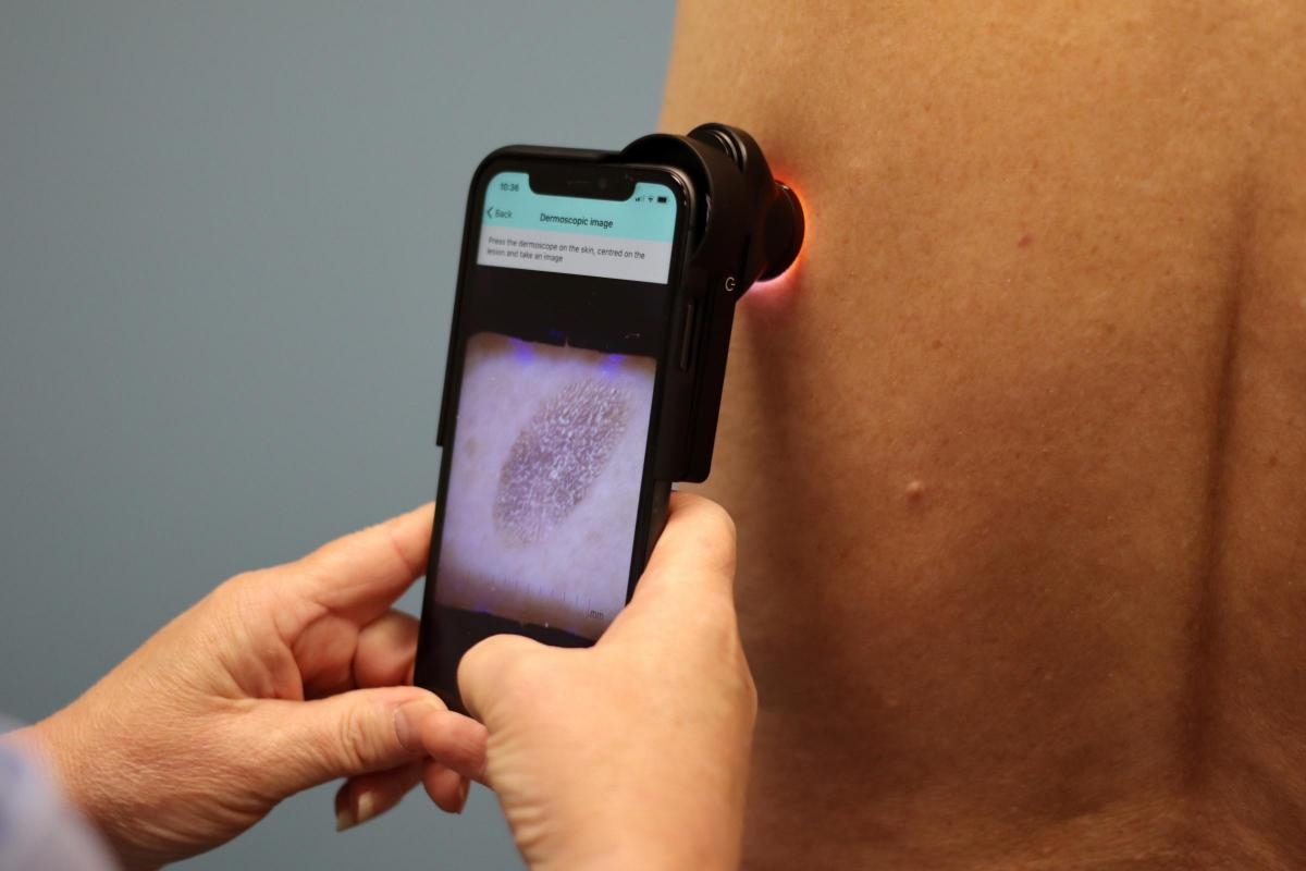 Warrington Hospital to use AI to speed up diagnosis of skin cancer