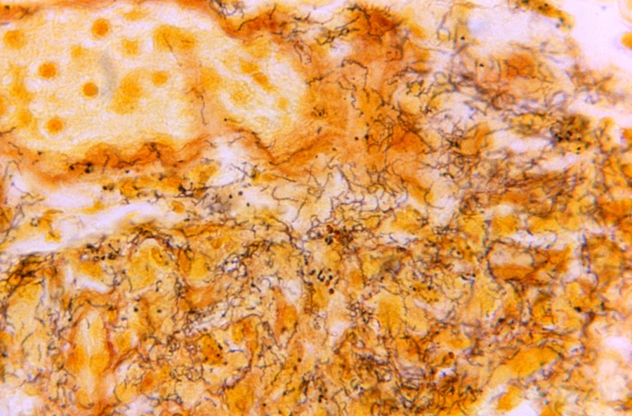 Hampton Roads health leaders look to combat rise in syphilis cases