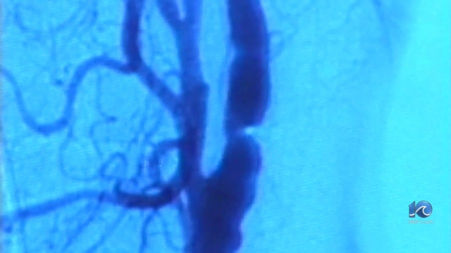 Patients as young as 8 reportedly having strokes in Hampton Roads