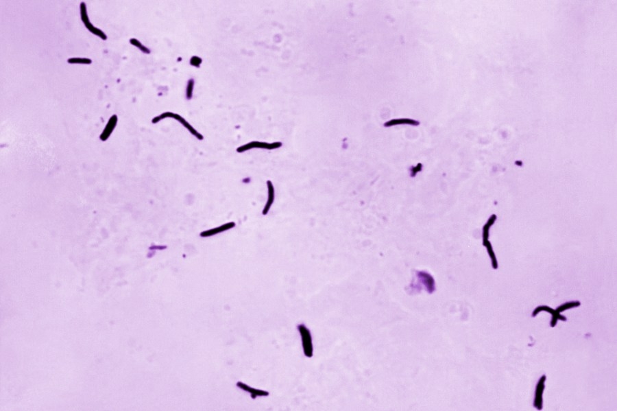 Johnson County Health Dept. responds to tuberculosis concerns