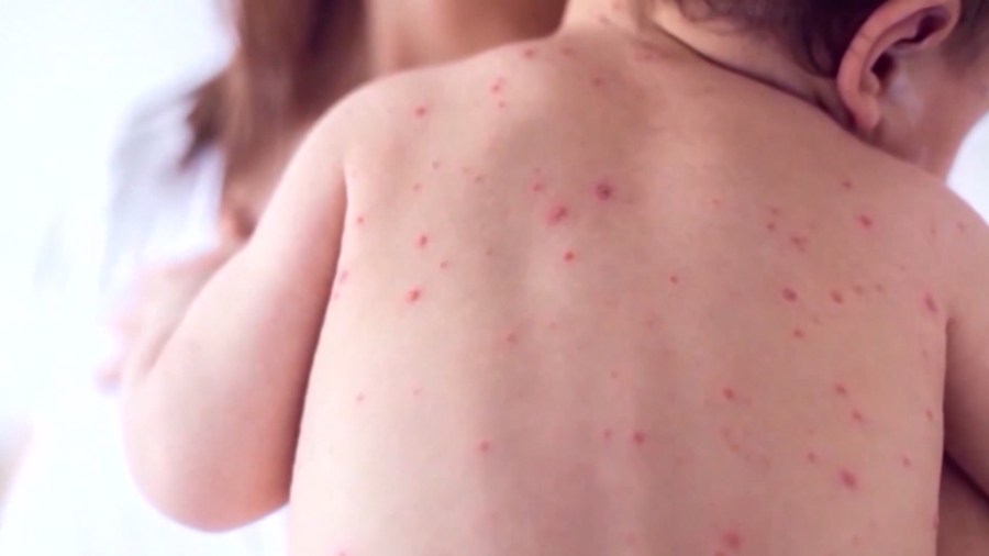 Medical leaders talk mitigating measles in Kentucky
