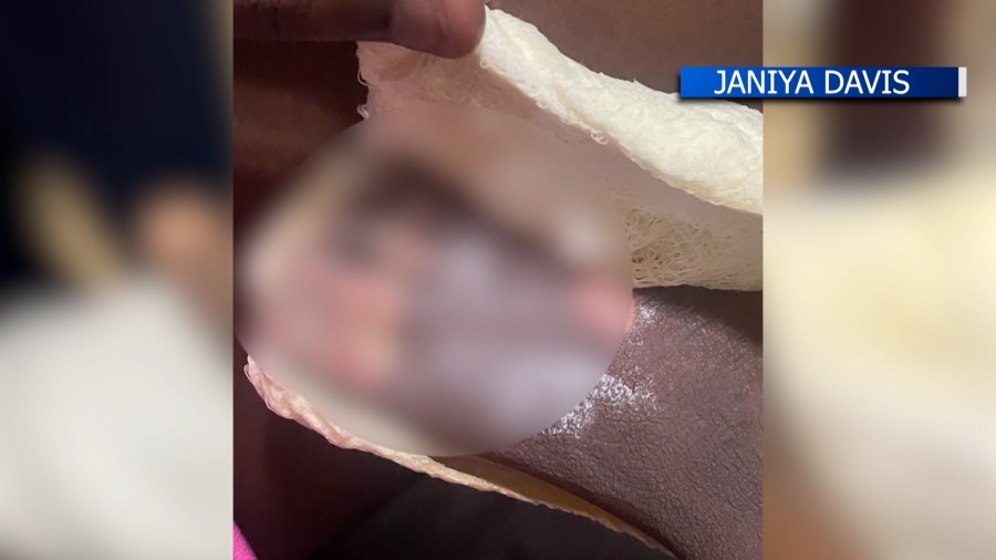 ‘I screamed': Woman, toddler suffer 3rd-degree burns from charcoal buried in sand