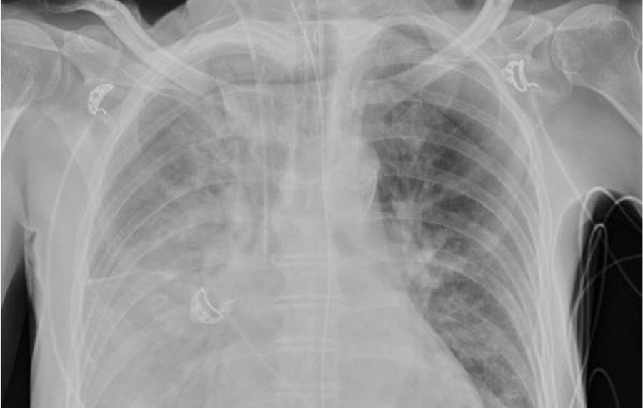 Man ends up in ICU after getting chlamydia from bird-feeding