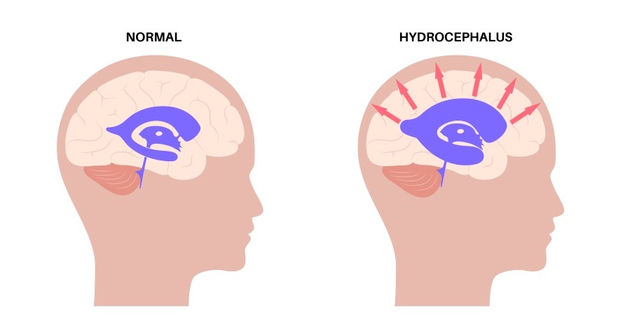 What is normal pressure hydrocephalus?