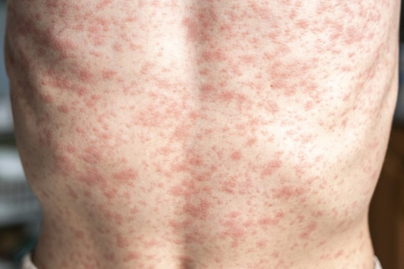 Pediatrician: Measles outbreak preventable in Iowa