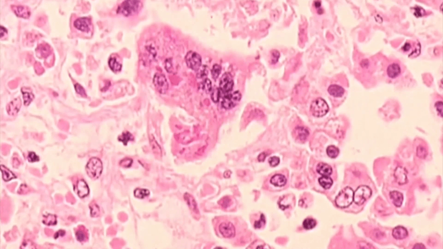 Erie County DOH declares measles outbreak amid fifth reported case