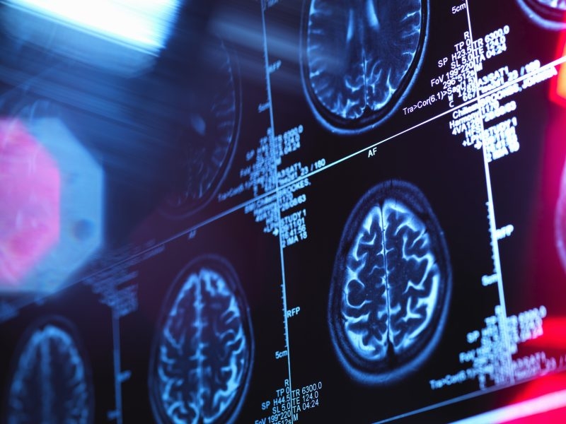 3 cases of rare brain disease reported in Oregon