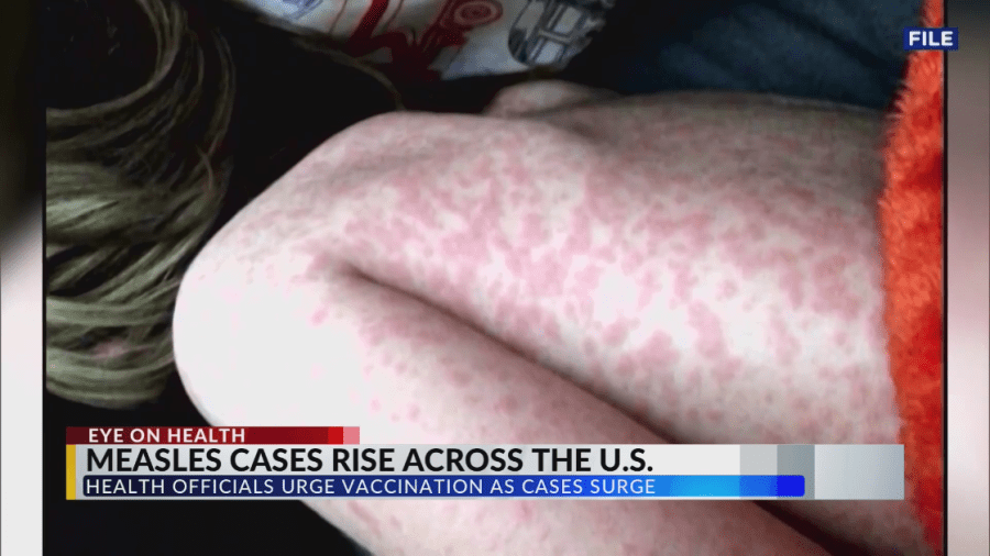 Local health officials on alert during measles outbreak