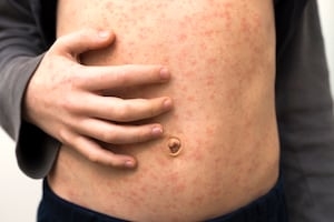 Measles cases growing across Georgia, doctors encouraging vaccines