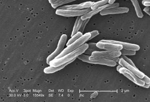 Tuberculosis cases are ‘rising' in Mecklenburg County