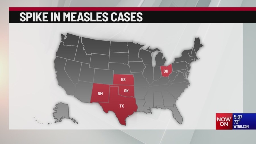 Rise in measles cases across U.S. cause for concern