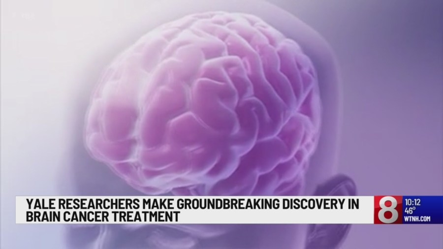 Yale researchers use lupus antibody to possibly treat glioblastoma