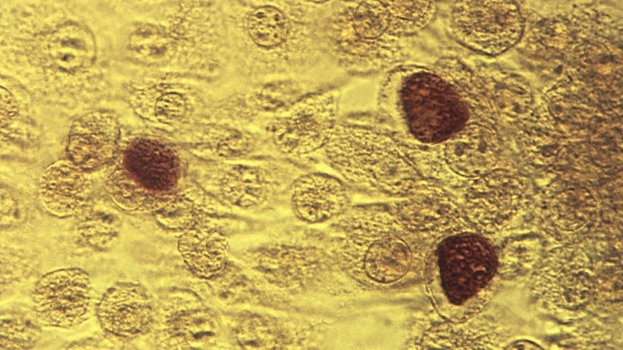 Syphilis cases drop statewide but rise in Baton Rouge, LDH says