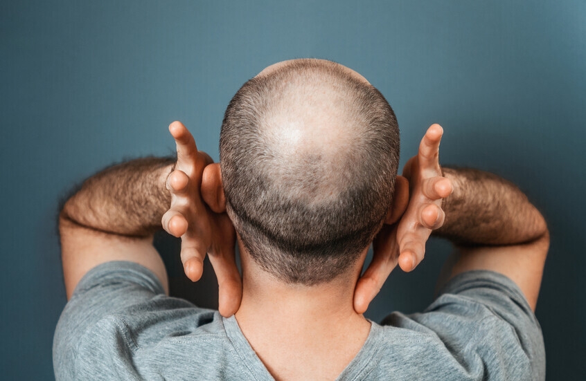 خلطة طبيعية من لحاء "شجرة الحب" وقشر اليوسفي قد تقضي على الصلع!