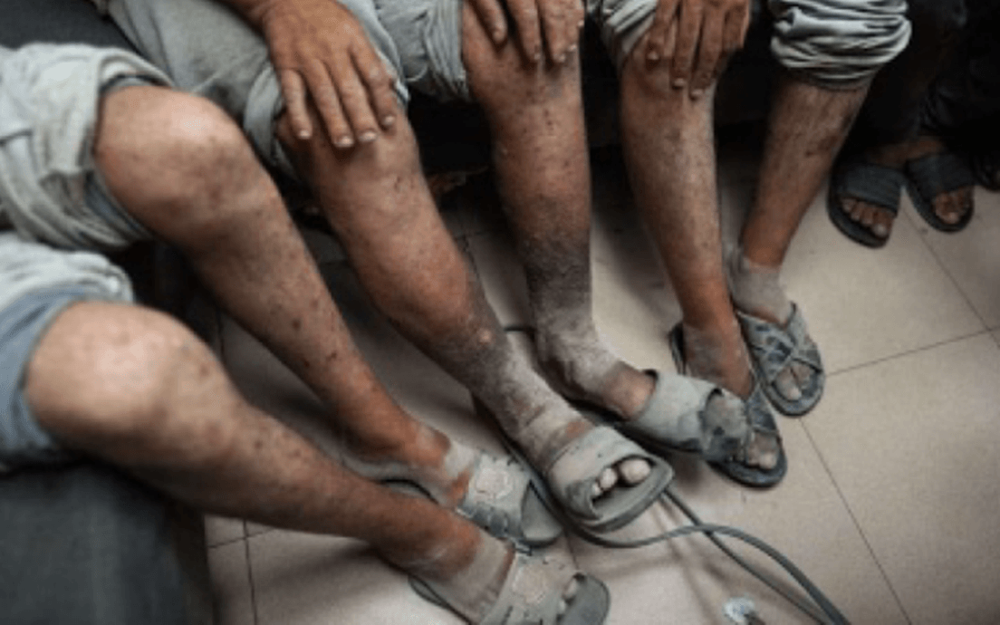 تفشي الجرب يكشف أزمة متصاعدة في السجون الإسرائيلية وسط اتهامات بالإهمال وغياب العدالة