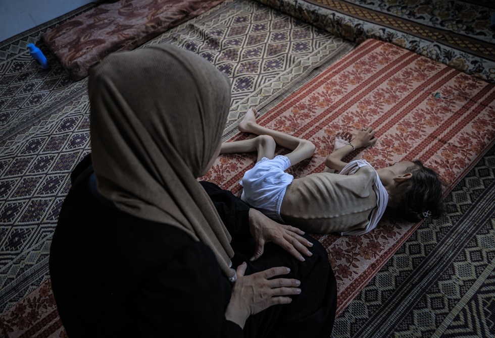 صحة غزة: ارتفاع حصيلة ضحايا الجوع في غزة إلى 180 بينهم 93 طفلا