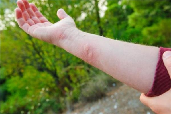 تعرف على ما يجب فعله عند التعرض للدغات البعوض