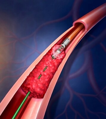 BD to Initiate Real-World Patient Data Registry for the Rotarex™ Atherectomy System in Treatment of Peripheral Artery Disease