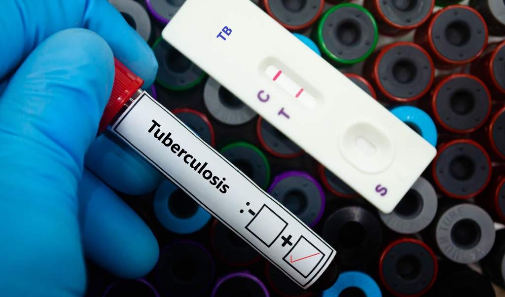 TB's tight grip: Why this curable disease is so hard to treat