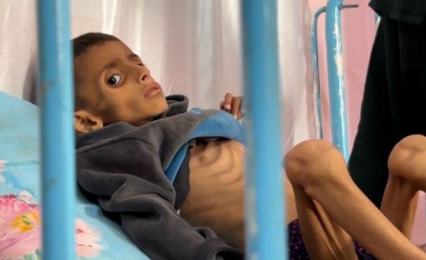 الأمم المتحدة: وفاة أكثر من 100 طفل في غزة بسبب سوء التغذية