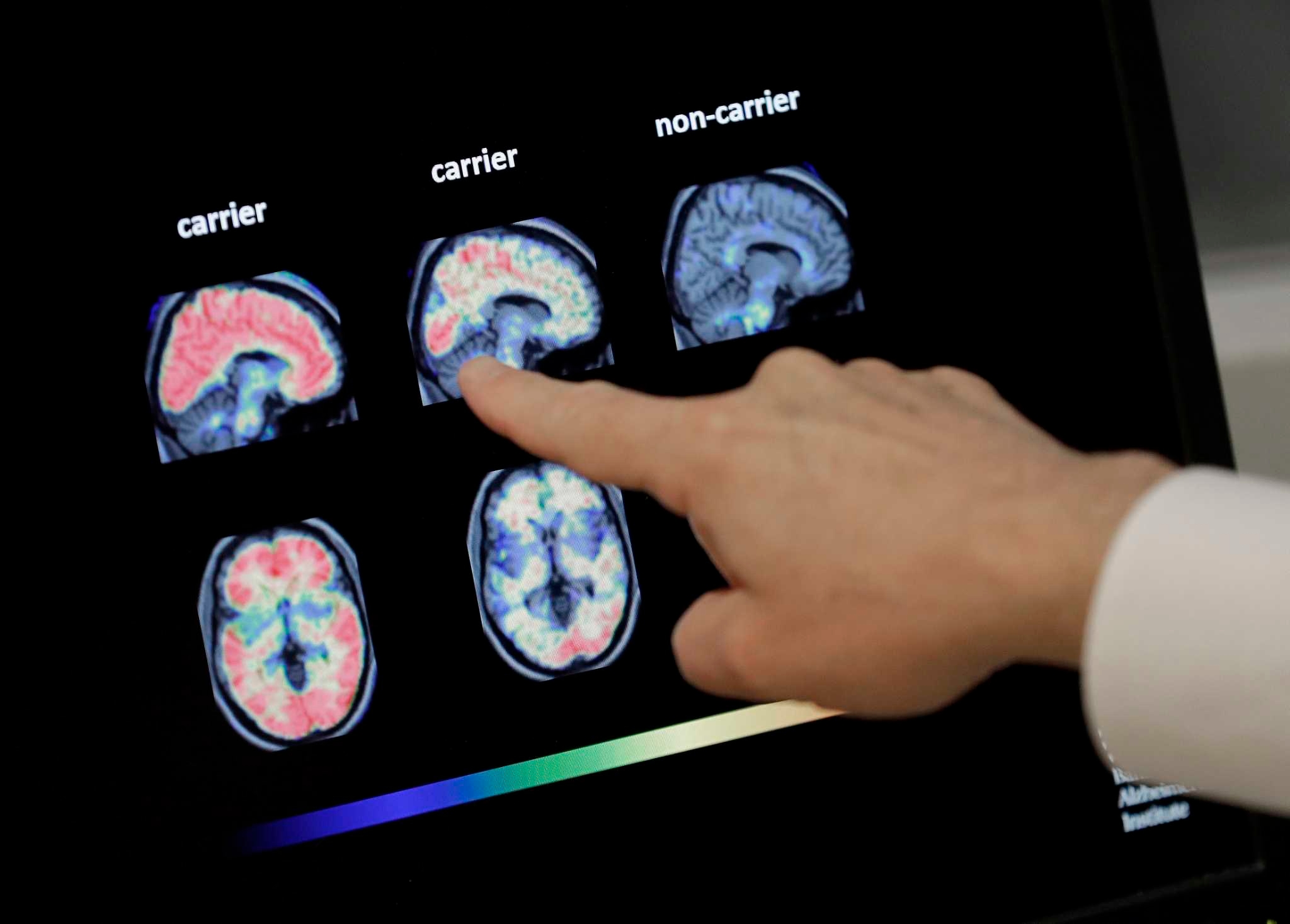 Letters: We need a cure for Alzheimer's. Why isn't the Trump administration fully funding research?