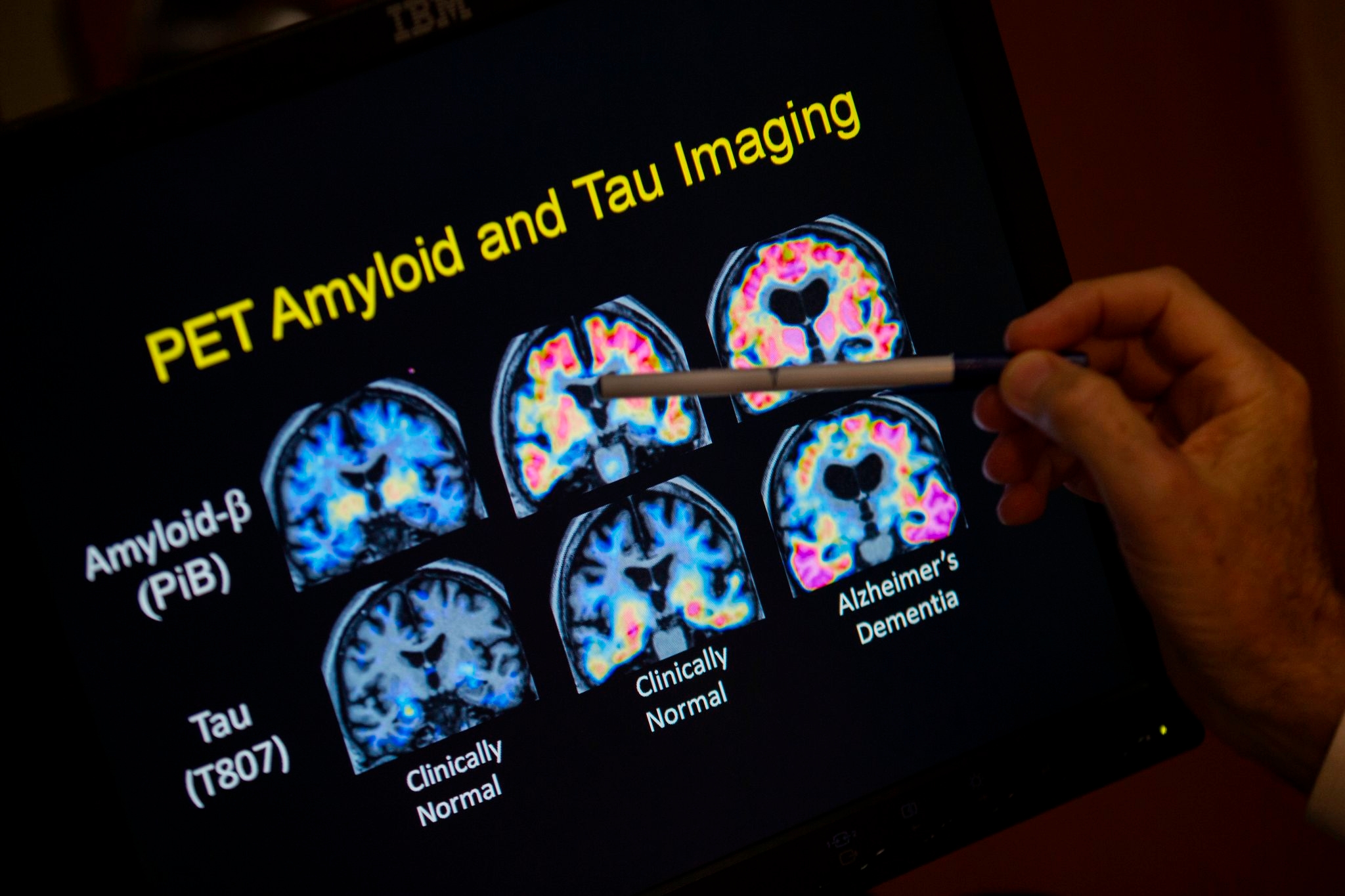 FDA OKs first blood test that can help diagnose Alzheimer's disease