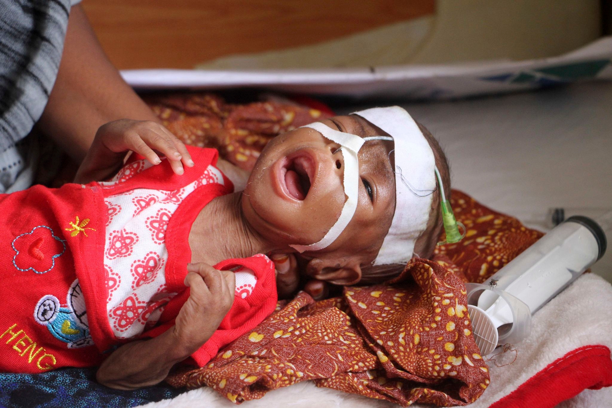 US aid kept many hungry Somali children alive. Now that money is disappearing