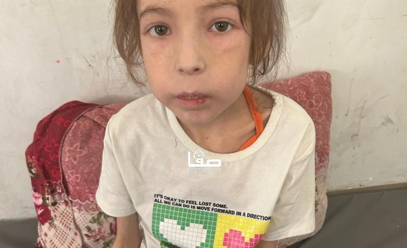 "رهف".. الجوع يلتهم جسدها دون مغيث