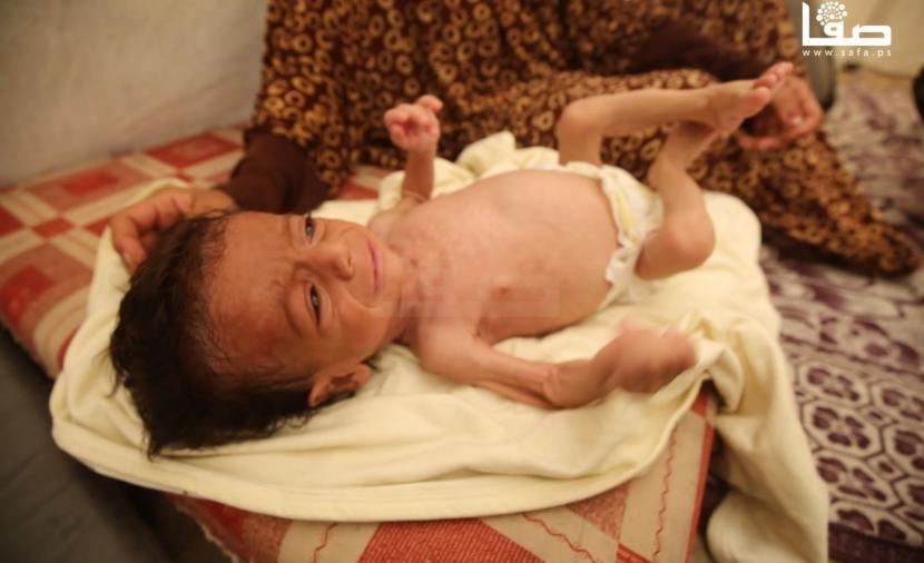 المجاعة تشتّد بغزة.. أطفال تحولوا لـ"هياكل عظمية" وسط صرخات لا تنقطع