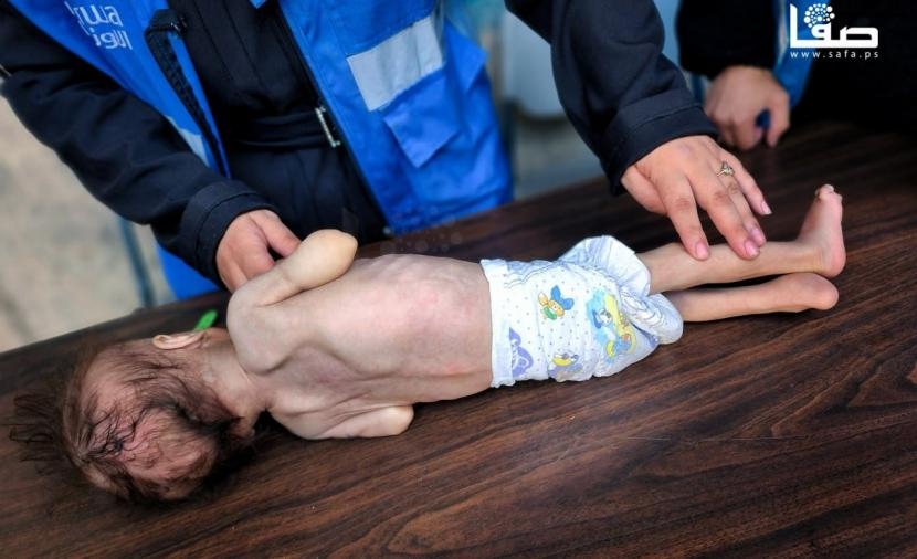 المجاعة تفتك بأطفال غزة ومخاوف حقيقية من زيادة كبيرة في الوفيات