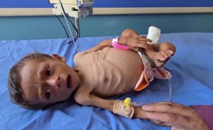 5 وفيات بغزة نتيجة المجاعة وسوء التغذية خلال 24 ساعة
