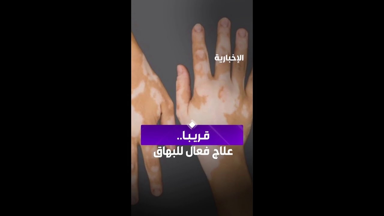 فيديو "هناك دواء قوي قادم يسمى "مثبطات جاك" لمرضى البهاق "
