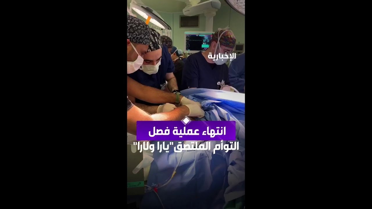 فيديو انتهاء عملية فصل التوأم الملتصق "يارا ولارا"